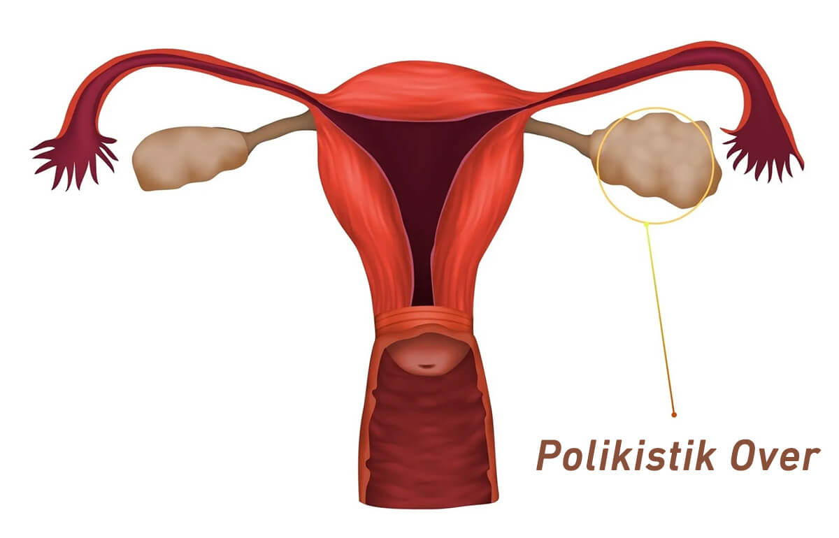 Polikistik over sendromu